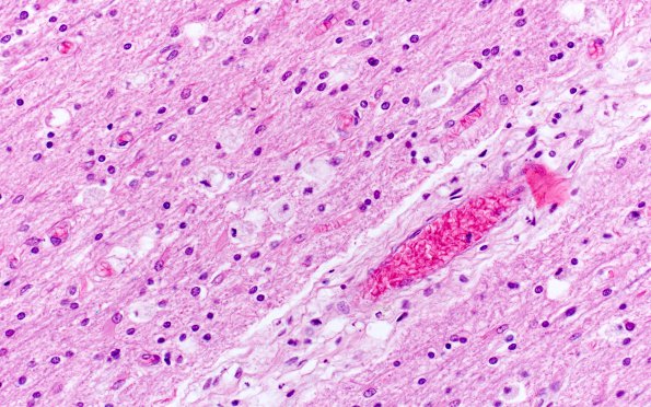 7C2 Mucopolysaccharidosis (WUMS Teaching set) H&E 9