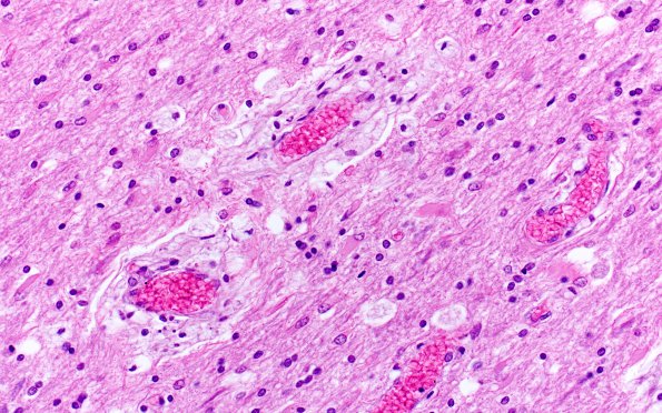 7C3 Mucopolysaccharidosis (WUMS Teaching set) H&E 3