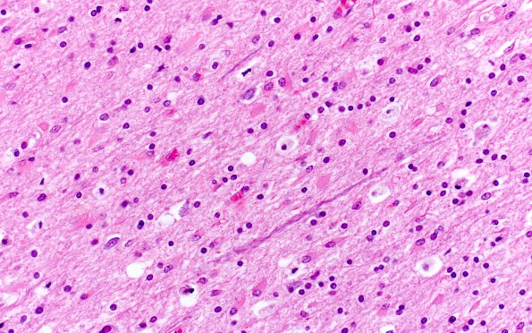 7C4 Mucopolysaccharidosis (WUMS Teaching set) H&E 11