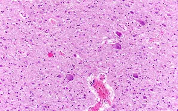 7D1 Mucopolysaccharidosis (WUMS Teaching set) H&E 7