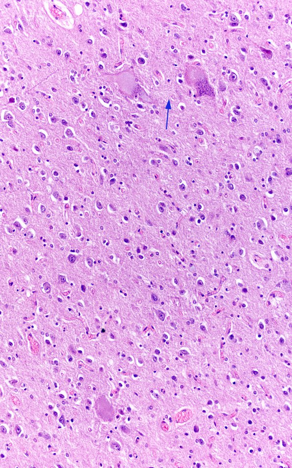 7D2 Mucopolysaccharidosis (WUMS Teaching set) H&E 5 copy