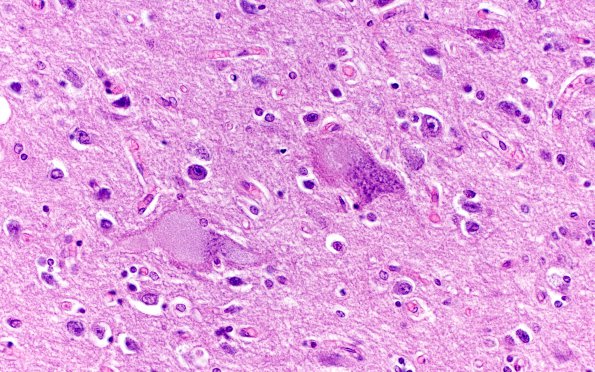 7D3 Mucopolysaccharidosis (WUMS Teaching set) H&E 6