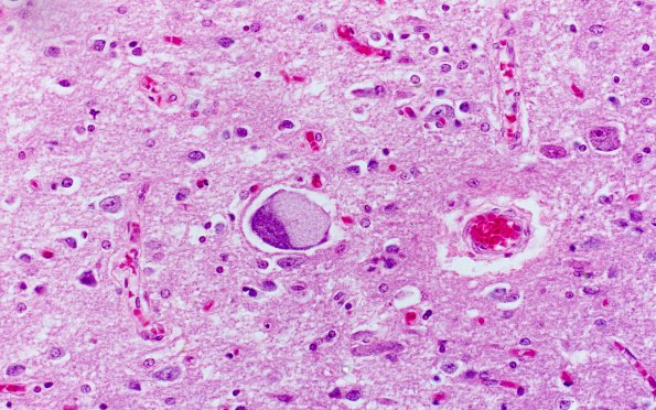 7D4 Mucopolysaccharidosis (WUMS Teaching set) H&E 13