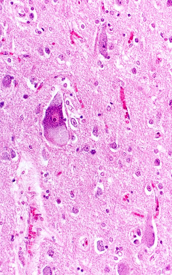 7D5 Mucopolysaccharidosis (WUMS Teaching set) H&E 1