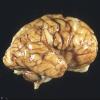 1A1 Multiple Acyl CoA Dehydrogenase deficiency, Case 1) 1