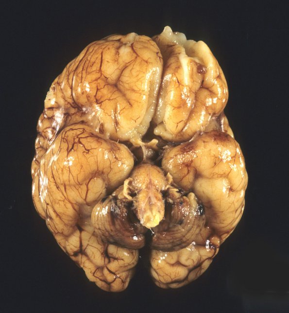 1A2 Multiple Acyl CoA Dehydrogenase deficiency, Case 1) 2