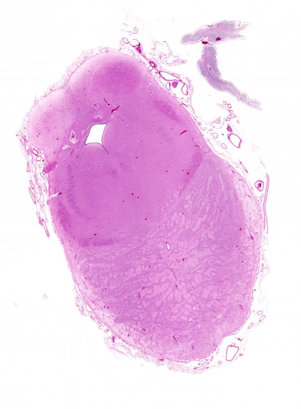 1B1 Glutaric Acidemia, type 2 (Case 1) N8 Pons whole mount