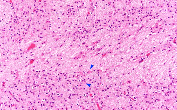 1B2 Multiple Acyl CoA Dehydrogenase deficiency, Case 1) N8 H&E 20X copy