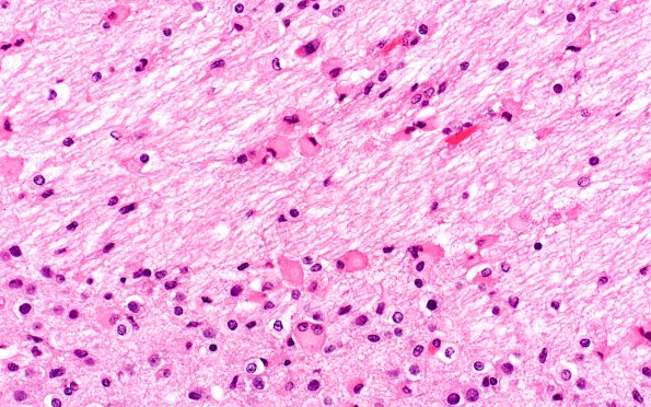 1B3 Multiple Acyl CoA Dehydrogenase deficiency, Case 1) N8 H&E 40X