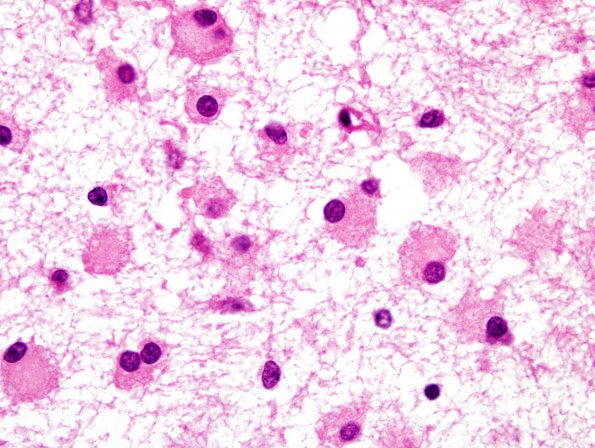 1B4 Multiple Acyl CoA Dehydrogenase deficiency, Case 1) H&E 15