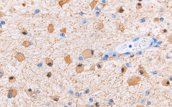 1C2 Multiple Acyl CoA Dehydrogenase deficiency, Case 1) N8 GFAP 60 4X