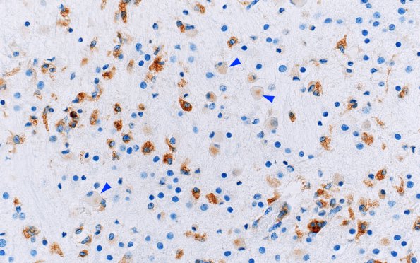 1D2 Multiple Acyl CoA Dehydrogenase deficiency, Case 1) N8 CD68 40X 1 copy