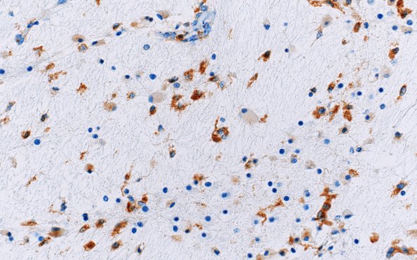 1D3 Multiple Acyl CoA Dehydrogenase deficiency, Case 1) N8 CD68 40X 2