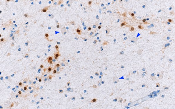 1E Multiple Acyl CoA Dehydrogenase deficiency, Case 1) N8 NeuN 40X copy