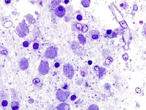 1F Multiple Acyl CoA Dehydrogenase deficiency, Case 1) Pons Plastic 1