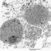 1G1 Multiple Acyl CoA Dehydrogenase deficiency, Case 1) EM 2 - Copy (2)