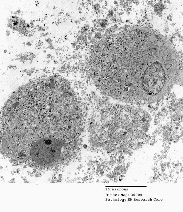 1G1 Multiple Acyl CoA Dehydrogenase deficiency, Case 1) EM 2 - Copy (2)