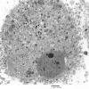 1G2 Multiple Acyl CoA Dehydrogenase deficiency, Case 1) EM 8 - Copy