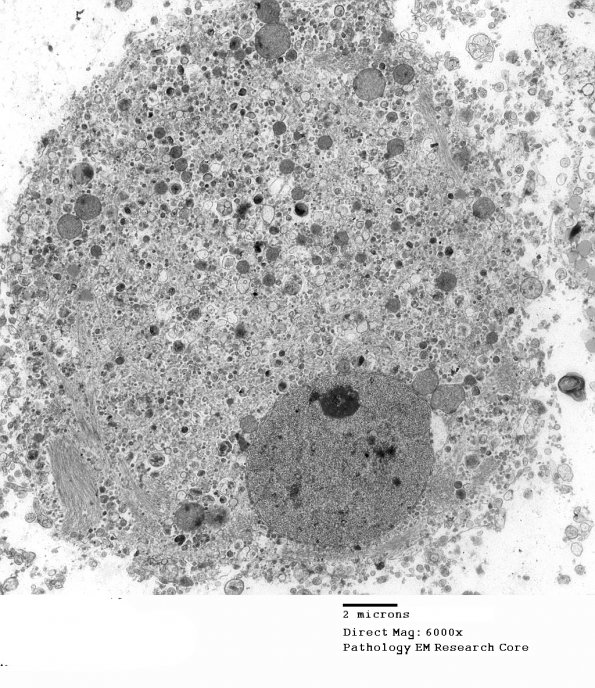 1G2 Multiple Acyl CoA Dehydrogenase deficiency, Case 1) EM 8 - Copy