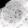 1G3 Multiple Acyl CoA Dehydrogenase deficiency, Case 1) EM 1 - Copy copy