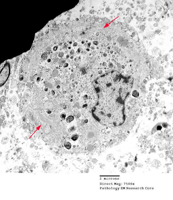 1G3 Multiple Acyl CoA Dehydrogenase deficiency, Case 1) EM 1 - Copy copy