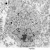 1G4 Multiple Acyl CoA Dehydrogenase deficiency, Case 1) EM 3 - Copy