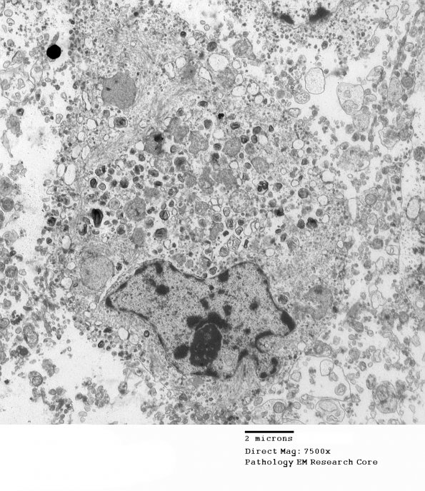 1G4 Multiple Acyl CoA Dehydrogenase deficiency, Case 1) EM 3 - Copy