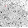 1G5 Multiple Acyl CoA Dehydrogenase deficiency, Case 1) EM 6 - Copy copy