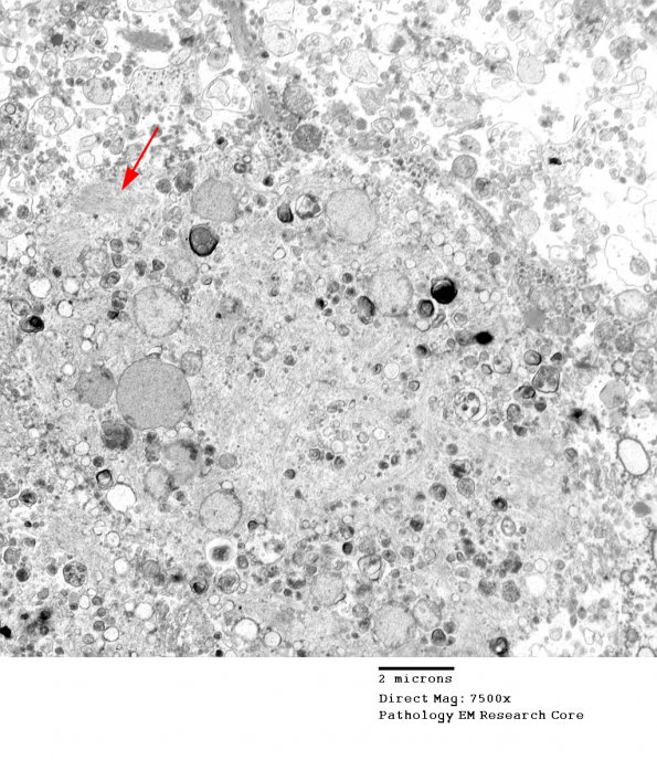 1G5 Multiple Acyl CoA Dehydrogenase deficiency, Case 1) EM 6 - Copy copy