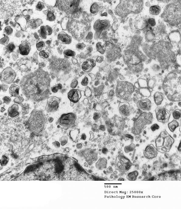 1G6 Multiple Acyl CoA Dehydrogenase deficiency, Case 1) EM 7 - Copy