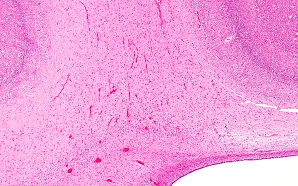 1H2 Multiple Acyl CoA Dehydrogenase deficiency (Case 1 N5 H&E 2X