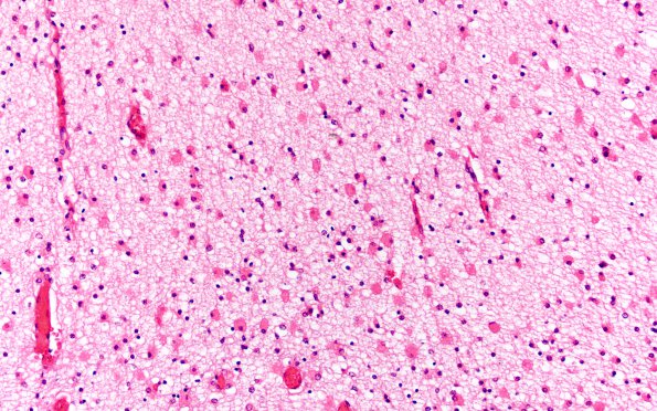 1H3 Multiple Acyl CoA Dehydrogenase deficiency (Case 1) N5 H&E 20X