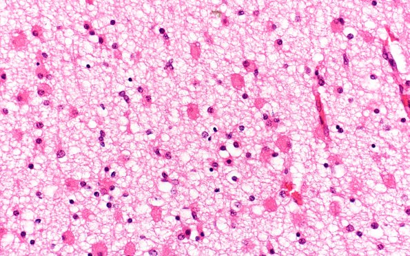 1H4 Multiple Acyl CoA Dehydrogenase deficiency (Case 1) N5 H&E 40X