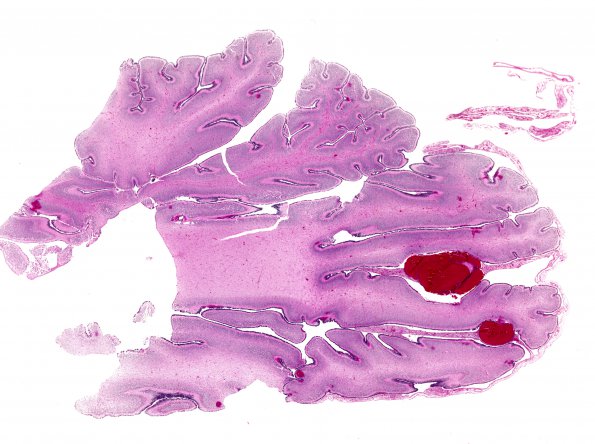 1I1 Multiple Acyl CoA Dehydrogenase deficiency (Case 1) N6 H&E whole mount