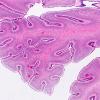 1I2 Multiple Acyl CoA Dehydrogenase deficiency (Case 1) N6 H&E 2X 2