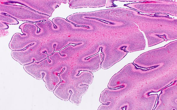 1I2 Multiple Acyl CoA Dehydrogenase deficiency (Case 1) N6 H&E 2X 2