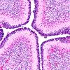 1I3 Multiple Acyl CoA Dehydrogenase deficiency (Case 1) N6 H&E 20X 2