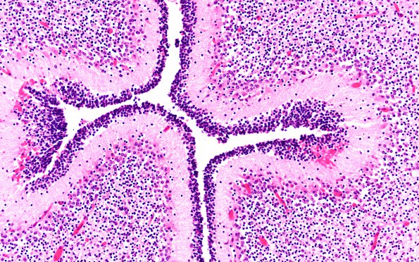 1I3 Multiple Acyl CoA Dehydrogenase deficiency (Case 1) N6 H&E 20X 2