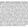 0A Neuronal Ceroid Lipofuscinosis - Text
