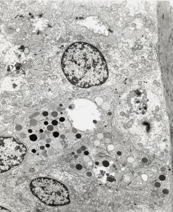 10A1 NCL (Case 10) Skin EM 1 - Copy