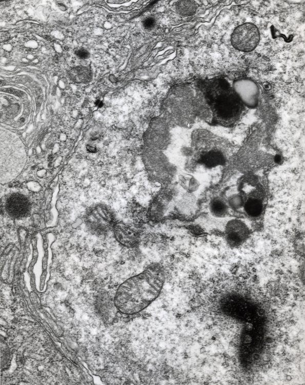 10A2 NCL (Case 10) Skin EM 4 - Copy