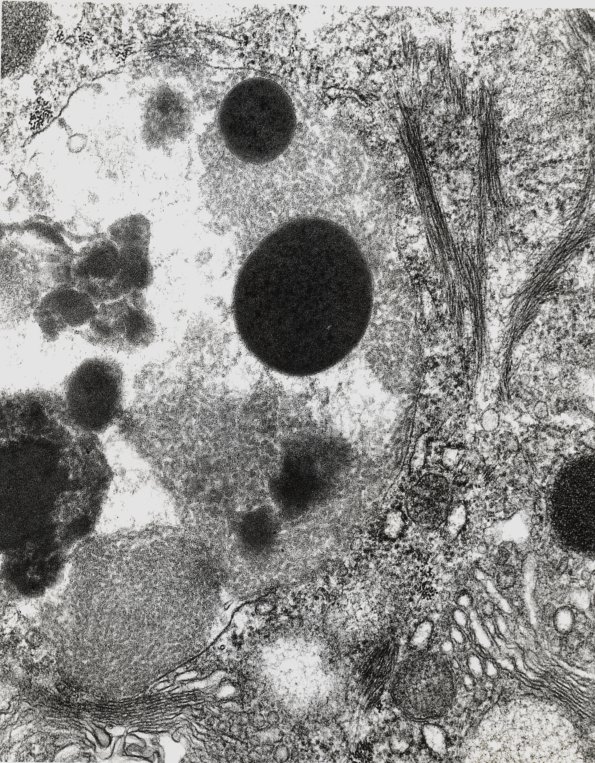 10A3 NCL (Case 10) Skin EM 3 - Copy