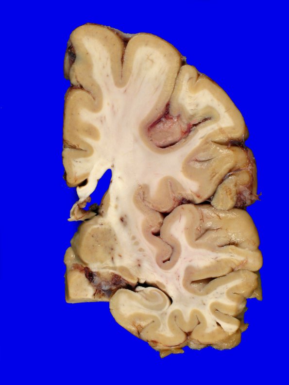 10B1 NCL (Case 10) Gross_19
