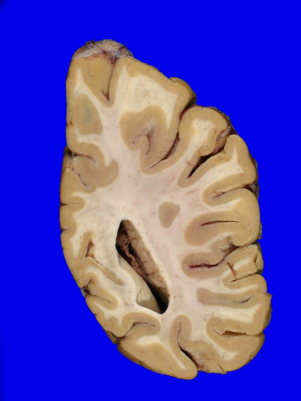10B2 NCL (Case 10) Gross_21