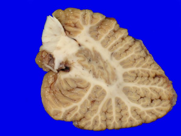 10B3 NCL (Case 10) Gross_26