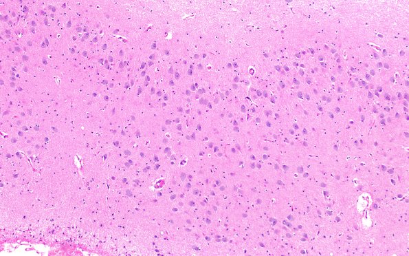 10C1 NCL (Case 10) N3 H&E 10x