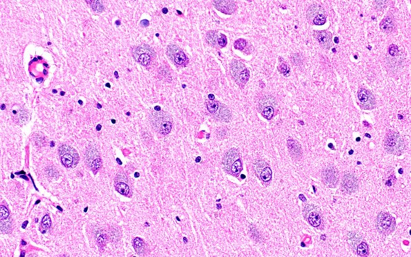 10C2 NCL (Case 10) N3 H&E 40X