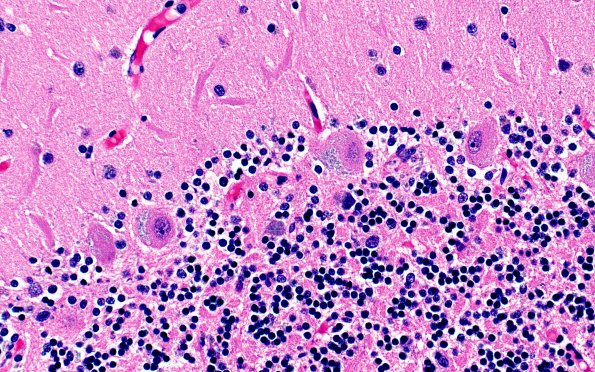 10C3 NCL (Case 10) L14 Cbell 40X