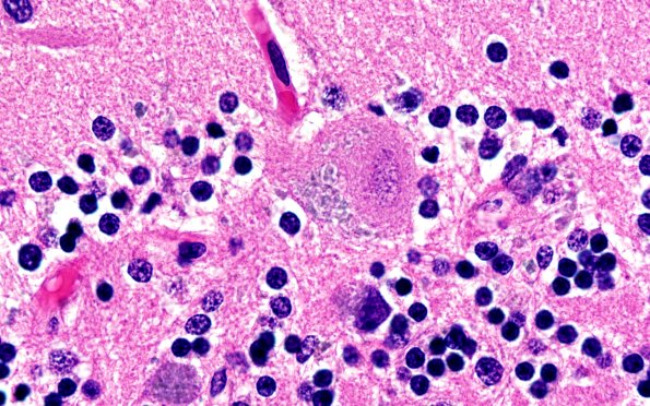 10C4 NCL (Case 10) L14 Cbell 100X