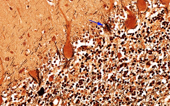 10C5 NCL (Case 10) L14 Cbell Biels 40X copy